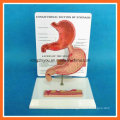 Human Ulcer Stomach Model with Description Plate